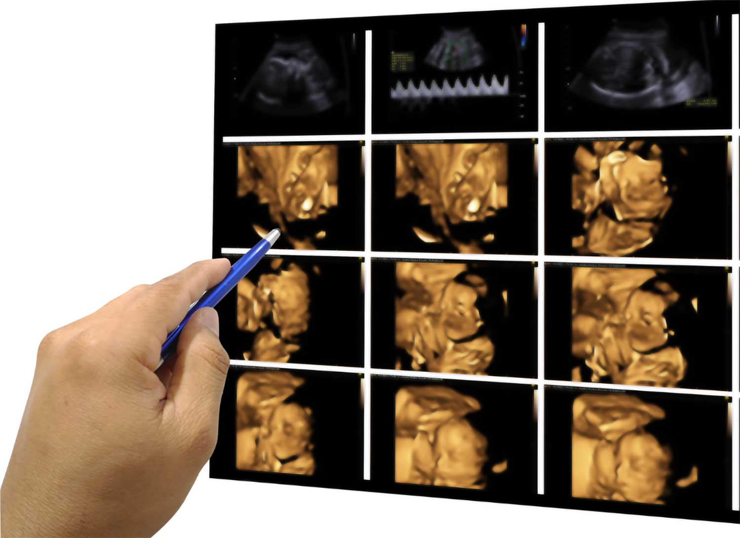 High-quality imaging results of a combined 3D and 4D ultrasound