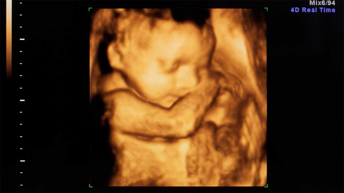 benefits of 3D ultrasound imaging