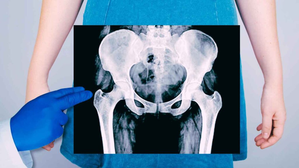 X-ray of female pelvis showing signs of pelvic organ prolapse 