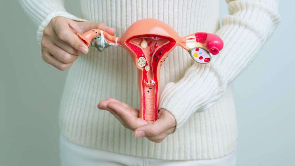 Managing Endometriosis Pain.
