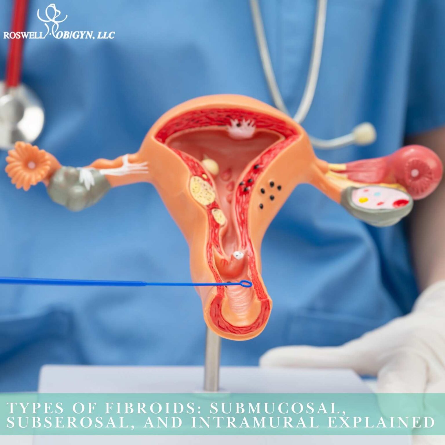 Types of Fibroids: Submucosal, Subserosal & Intramural