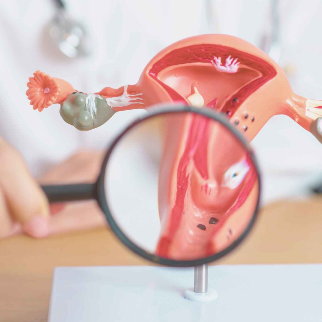Uterine Fibroids Symptoms and Causes.
