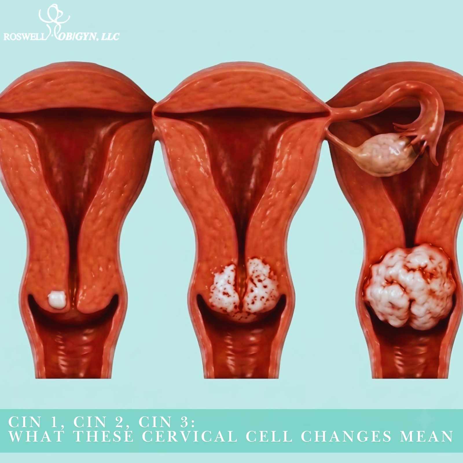 Three illustrations compare CIN 1, CIN 2, and CIN 3 cervical cell changes, showing increasingly extensive abnormal tissue.